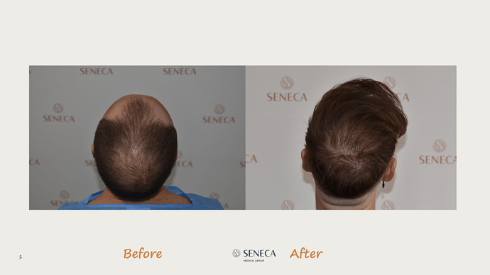 Seneca Medical Group - 3200 grafts with Direct Fue photo