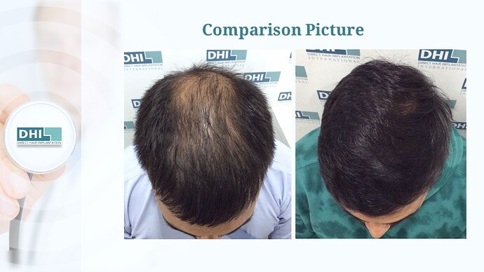 DHI India™ | Crowning Glory Restored | 2,650 Grafts | 8 Months Hair Transplant Result photo