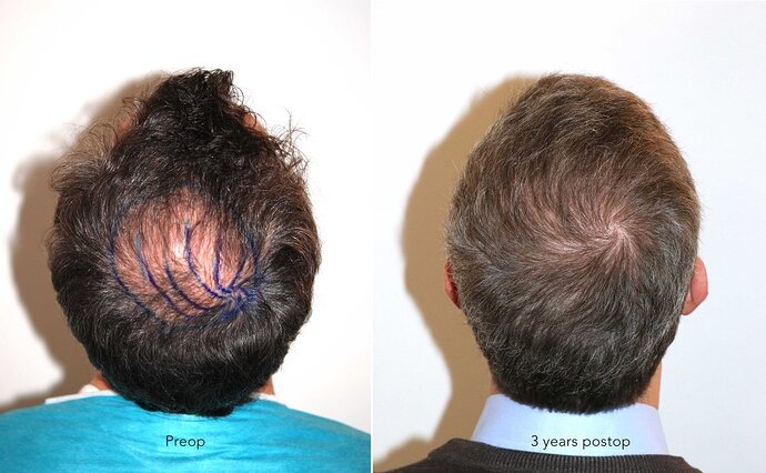 Case performed by Dr. Feriduni – 3883 FU in 1 procedure photo