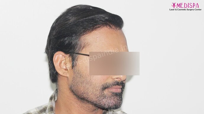 Revision Hair Transplant - 5111 Grafts / 5 Years Result - Dr. Suneet Soni, Medispa India photo