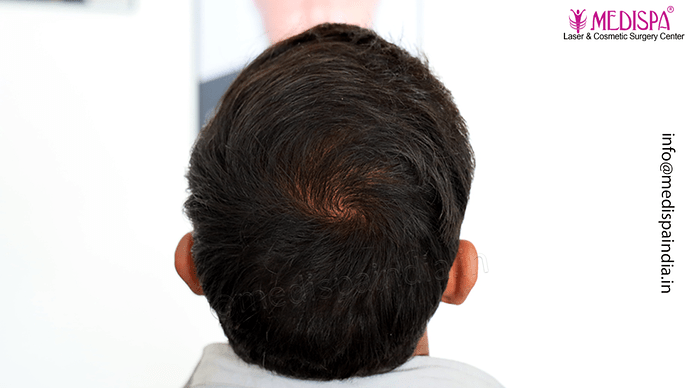 Dr. Suneet Soni - 5360 Grafts | 12-Month Result | Combination FUT + FUE + Beard photo