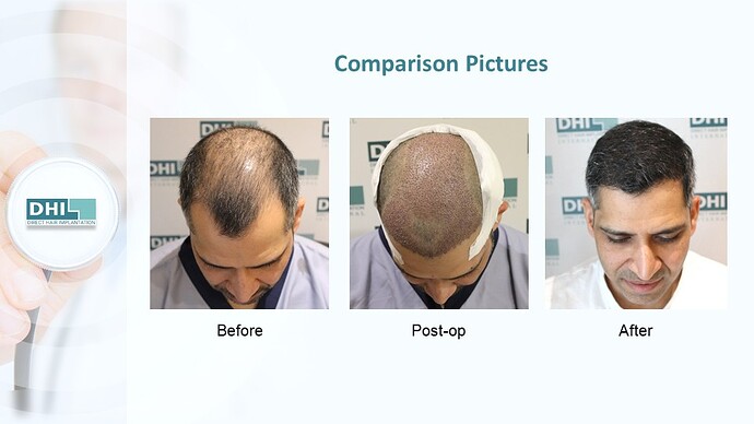 DHI India™ | NW 5 | 2,985 Grafts | 12 Months DHI Hair Transplant Results photo