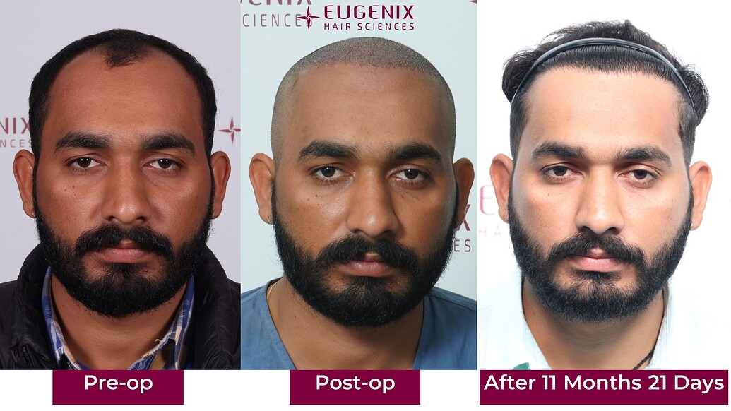 https://cdn.forumhairtransplant.com/optimized/3X/0/6/065f37a11169aa96829fdae3ba182ae8d0e3399f_2_1035x582.jpeg