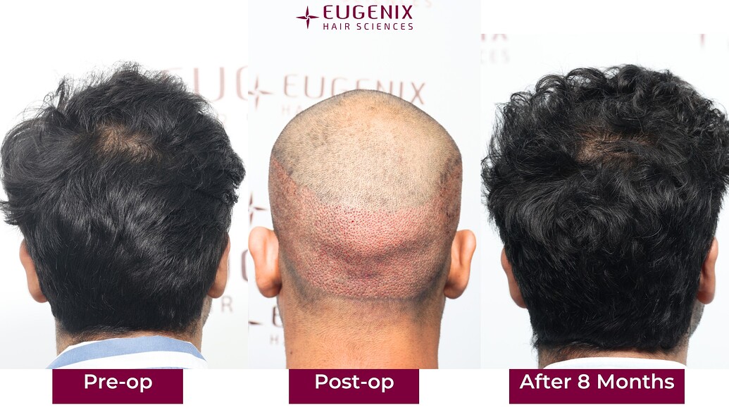 https://cdn.forumhairtransplant.com/optimized/3X/0/6/06668f72fccfe0dbb3e5fe4d62ba0833814d38d7_2_1035x582.jpeg