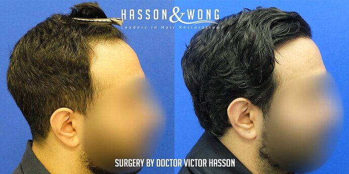 Dr. Hasson / 2,500 grafts / FUE / Hairline / 1 Year Post-op photo
