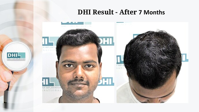 DHI India | NW 4 | 2,354 Grafts | 7-Months DHI Hair Transplant Results photo