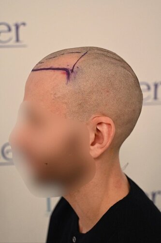 Ozlem Bicer MD-2340 Grafts FUE by micro-motor, 12. month result  photo