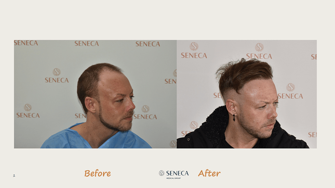 Seneca Medical Group - 3200 grafts with Direct Fue photo