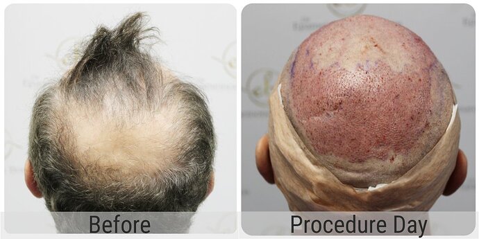 Dr Bonaros, Glasgow, UK / 3986 FUE grafts / 0-12 Months photo