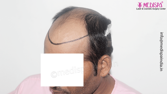 Dr. Suneet Soni - 4992 Grafts | 12-Month Result | Combination FUT + FUE + Beard photo