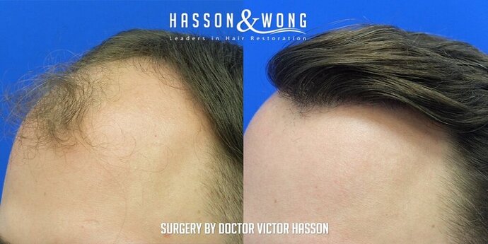 Dr. Hasson / 4,511 grafts / FUE / Frontal zone /mid / 3 years post-op photo