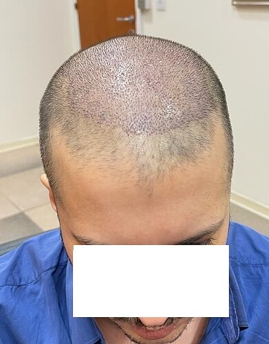 3400 grafts on a Diffuse Thinning case – 1 year after - HDC Hair Clinic photo