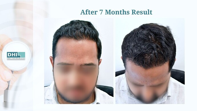 DHI India™ | NW 3 | 3,506 Grafts | 7 Months Hair Transplant photo