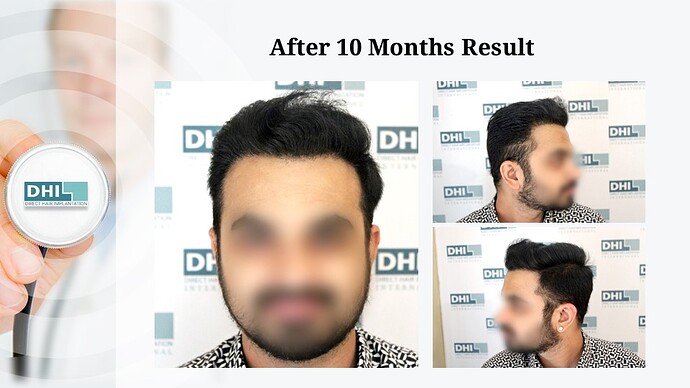 DHI India | Hair Line Reconstruction | Grade 3 | 2,088 Grafts | 10 Months Hair Transplant Results photo