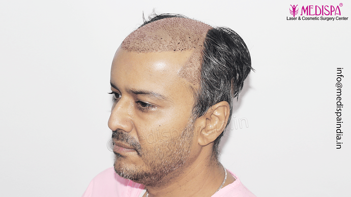 Dr. Suneet Soni - 4889 Grafts | 2.5 Years Result | Combination FUT + FUE + Beard photo