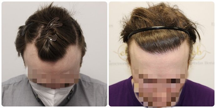 Dr Bonaros, Glasgow, UK / 1614 FUE grafts for receding Hairline / 0-12 Months photo