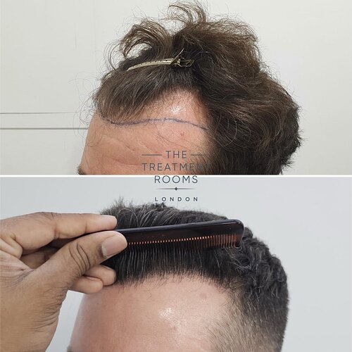 Hairline Transplant- 1745 Grafts- 14 Months Post Surgery photo