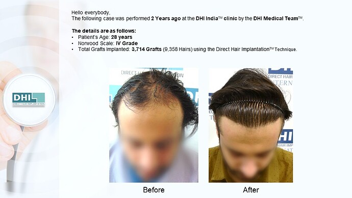 DHI India™ | NW 4 | 3,714 Grafts | 2 Years DHI Hair Transplant Result photo
