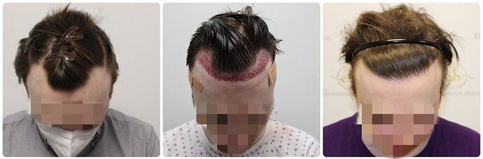 Dr Bonaros, Glasgow, UK / 1614 FUE grafts for receding Hairline / 0-12 Months photo