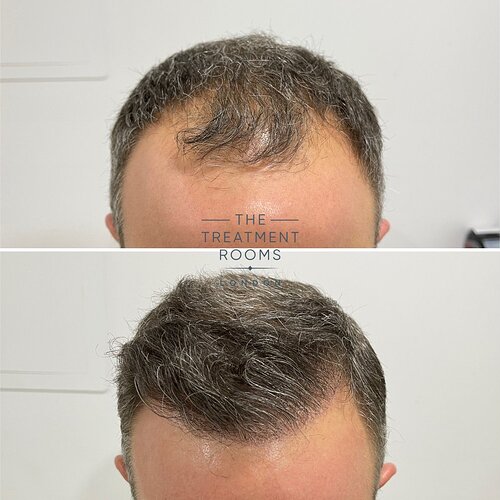 The Treatment Rooms London- 1788 Grafts Hairline Transplant Result photo