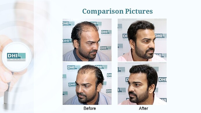 DHI India™ | NW 5 | 2,959 Grafts | 7 Months Hair Transplant Result photo