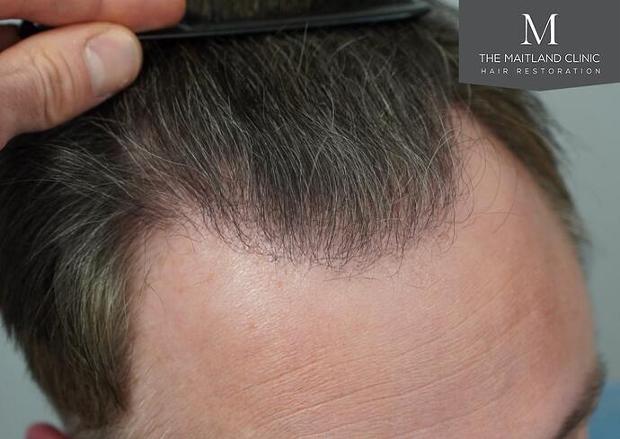 Dr Ball - The Maitland Clinic 2032 Grafts By FUE photo