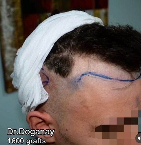 DR HAKAN DOGANAY/ 1600 GRAFTS / Implanter Pen+FUE photo