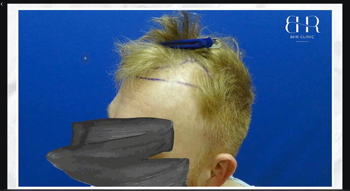Dr.Bisanga, BHR Clinic, 3500 FUE Hairline and Crown Reconstruction photo