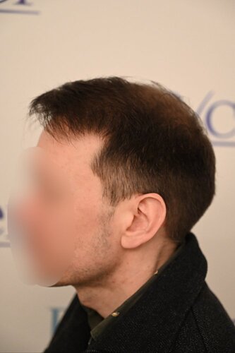 Ozlem Bicer MD-Hair Transplant-3980 Grafts FUE by micro-motor, 12. months result photo
