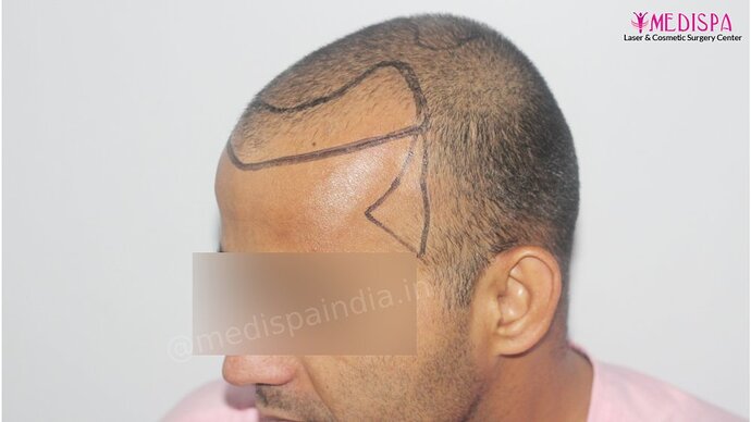 Dr. Suneet Soni - 4025 Grafts | 12-Month Result | Combination FUT + FUE photo