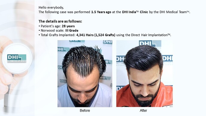DHI India™ | NW 3 | 1,524 Grafts | Youthful Hairline Restored | DHI Hair Transplant photo