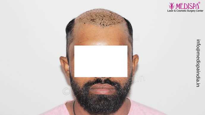 Dr. Suneet Soni - 5360 Grafts | 12-Month Result | Combination FUT + FUE + Beard photo