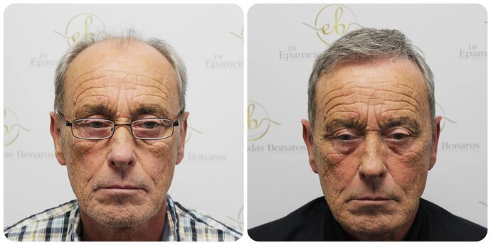 Dr Bonaros, Glasgow, UK / 3524 FUE grafts / 0-12 Months photo
