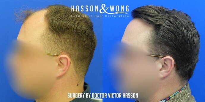 Dr. Hasson / 4,511 grafts / FUE / Frontal zone /mid / 3 years post-op photo