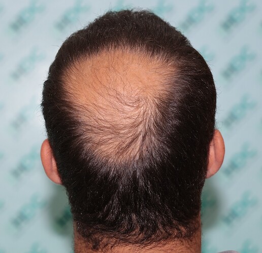 Result of 6800 FUE grafts in two sessions – 7 months after 2nd Session – Dr Maras – HDC Hair Clinic photo