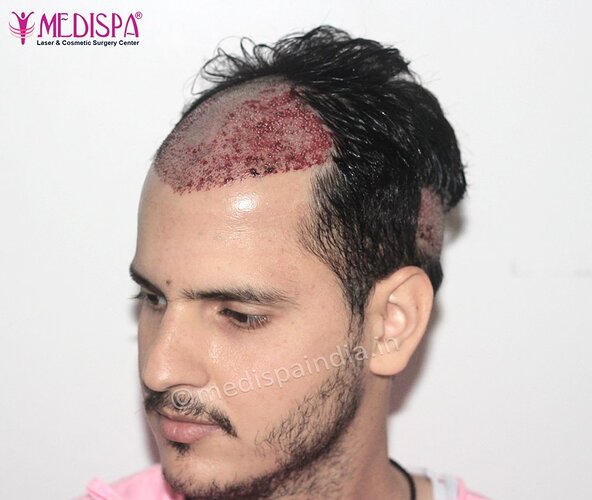 Dr. Suneet Soni - 2500 FUE Grafts, NW- III photo