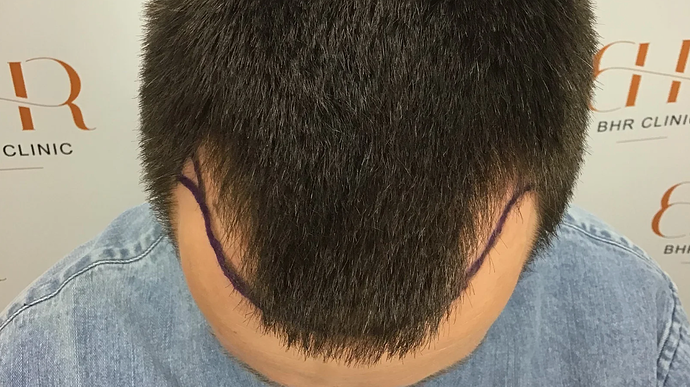 Dr. Bisanga & Dr. Kostis 2180 FUE 0 - 6 MONTHS - FAST AND NATURAL GROWTH! photo