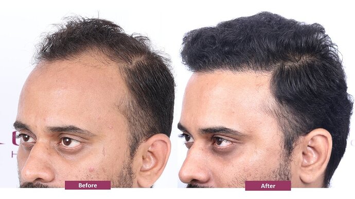 Eugenix Hair Sciences Clinic | Norwood Grade 3 | 22 Months Hair Transplant Results| photo