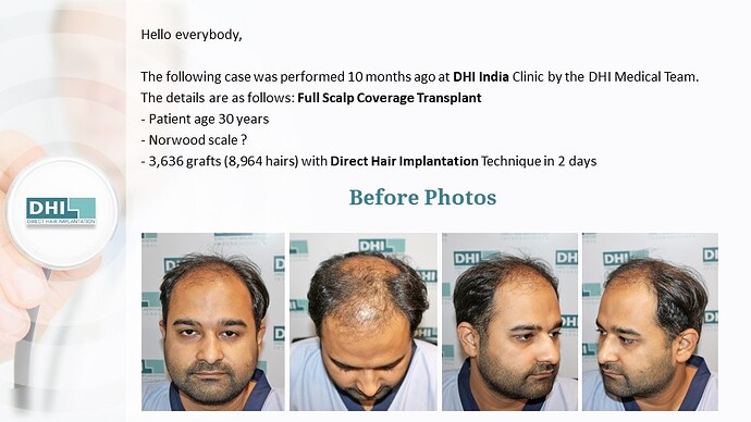 Full Scalp Coverage – 3,636 Grafts | DHI India Result photo