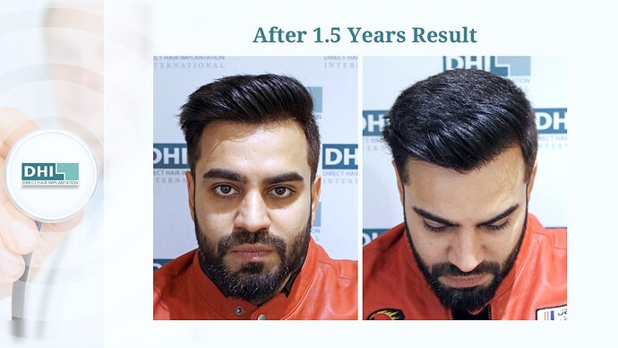 DHI India™ | NW 3 | 1,524 Grafts | Youthful Hairline Restored | DHI Hair Transplant photo