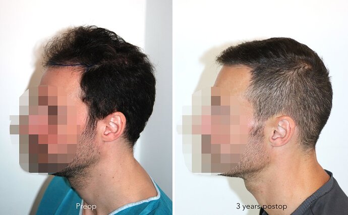 Case performed by Dr. Feriduni – 3255 FU in 1 procedure photo