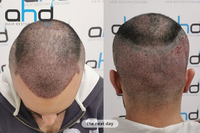 AHD Clinic / Technicians / 4050 grafts / FUE + DHI photo
