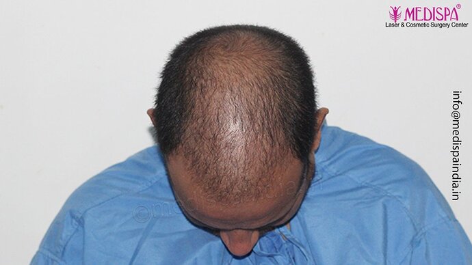 Dr. Suneet Soni - 4500 Grafts, Combine FUT + FUE Technique, NW-III photo