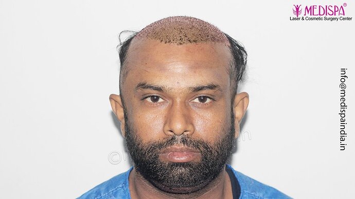 Dr. Suneet Soni - 5498 Grafts, 2 Years Result, Combine FUT + FUE + Beard Technique, NW-VI photo