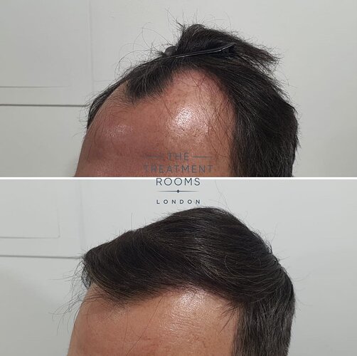 1800 Grafts Hairline, Temples and Crown FUE Hair Transplant photo