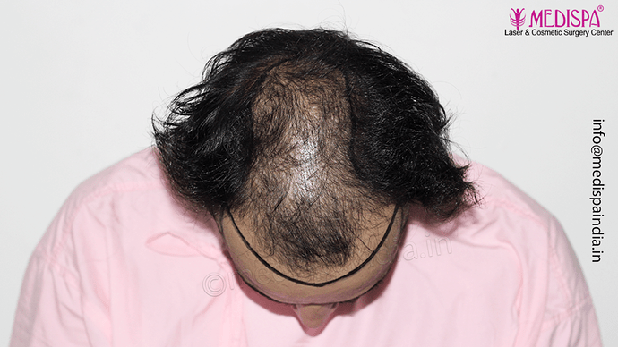 Dr. Suneet Soni - 4046 Grafts | 12-Month Result | Combination FUT + FUE + Beard photo