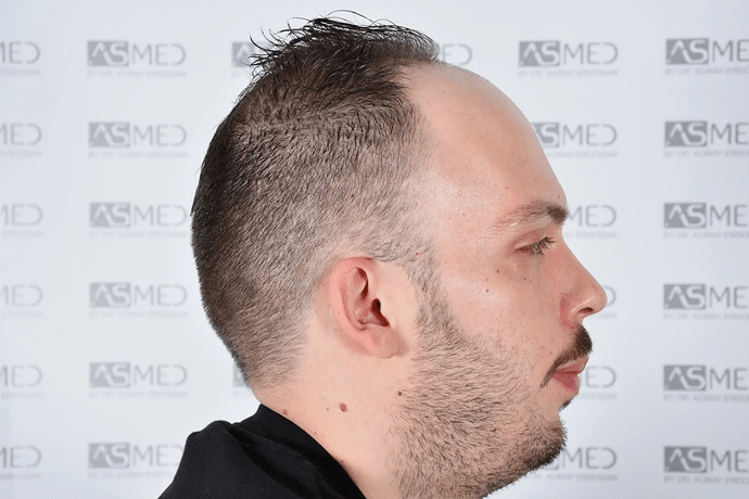 ASMED, Istanbul: 5,071 Manual FUE Grafts 0/12 Months photo