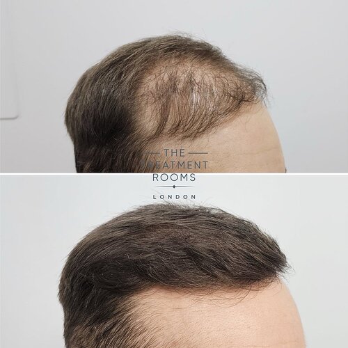 Hair Transplant Repair- 1733 Grafts photo