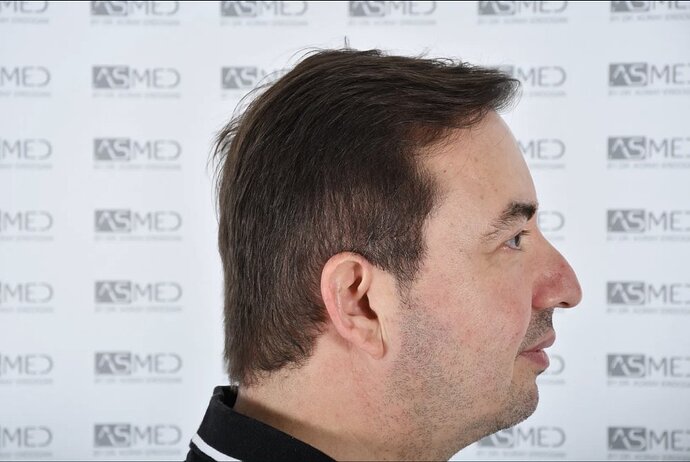 ASMED CLINIC - DR.KORAY - 5060 GRAFTS FUE photo