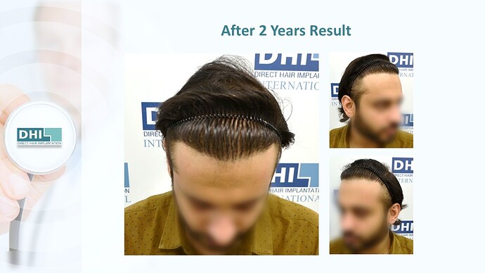 DHI India™ | NW 4 | 3,714 Grafts | 2 Years DHI Hair Transplant Result photo